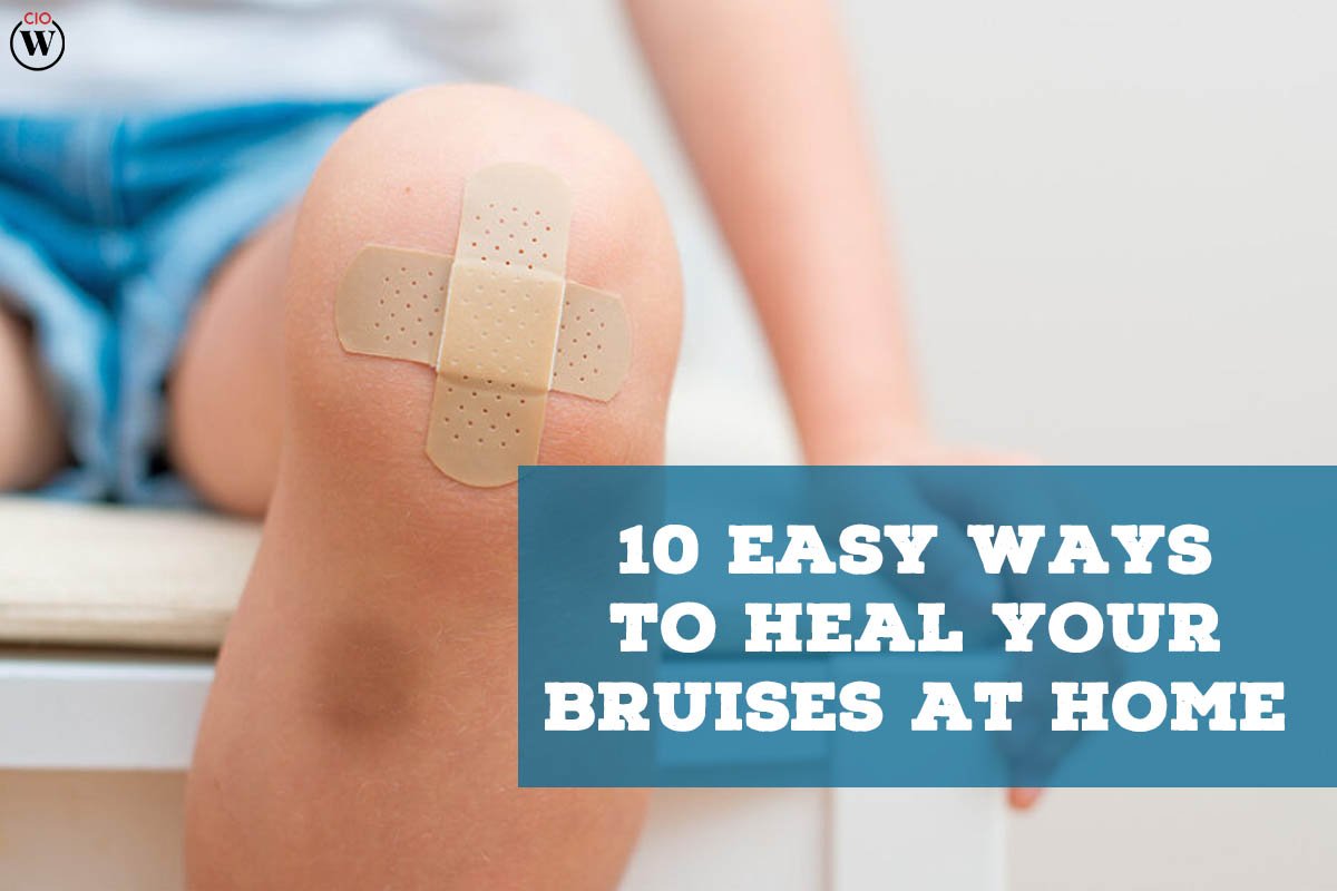 10 Easy ways to heal your Bruises at Home