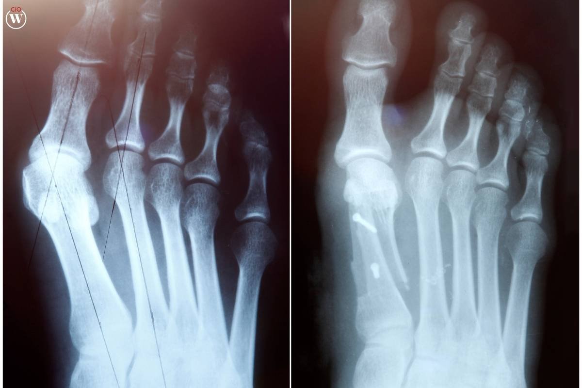 What is Osteoporosis and How to Manage It? | CIO Women Magazine